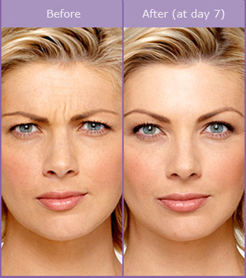 botox treatments for face