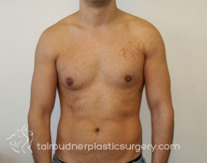 Male Breast Reduction (Gynecomastia)