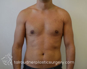 Male Breast Reduction (Gynecomastia)
