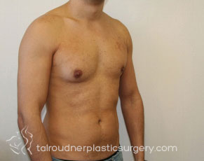 Male Breast Reduction (Gynecomastia)