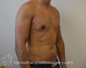 Male Breast Reduction (Gynecomastia)