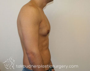 Male Breast Reduction (Gynecomastia)