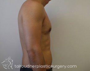 Male Breast Reduction (Gynecomastia)