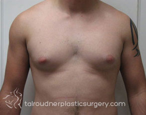 Male Breast Reduction (Gynecomastia)