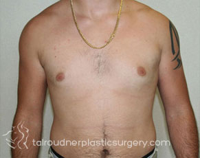 Male Breast Reduction (Gynecomastia)