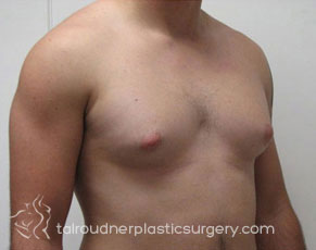 Male Breast Reduction (Gynecomastia)