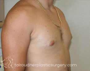 Male Breast Reduction (Gynecomastia)
