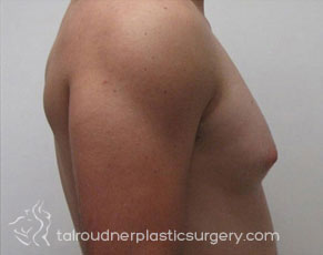 Male Breast Reduction (Gynecomastia)