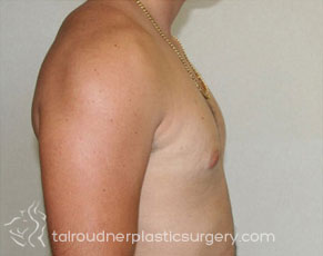 Male Breast Reduction (Gynecomastia)