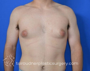 Male Breast Reduction (Gynecomastia)