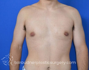 Male Breast Reduction (Gynecomastia)