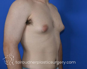 Male Breast Reduction (Gynecomastia)