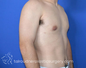 Male Breast Reduction (Gynecomastia)