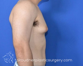 Male Breast Reduction (Gynecomastia)