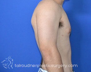 Male Breast Reduction (Gynecomastia)