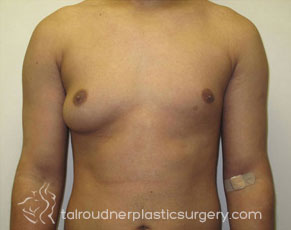 Male Breast Reduction (Gynecomastia)