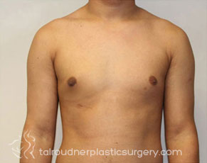 Male Breast Reduction (Gynecomastia)