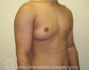 Male Breast Reduction (Gynecomastia)