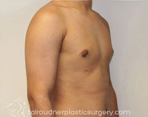 Male Breast Reduction (Gynecomastia)