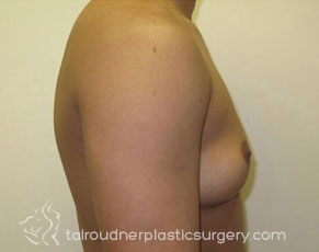Male Breast Reduction (Gynecomastia)