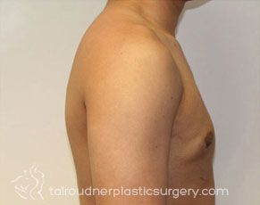 Male Breast Reduction (Gynecomastia)