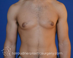 Male Breast Reduction (Gynecomastia)