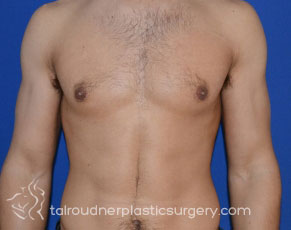 Male Breast Reduction (Gynecomastia)