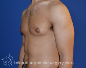Male Breast Reduction (Gynecomastia)