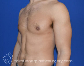 Male Breast Reduction (Gynecomastia)