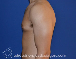 Male Breast Reduction (Gynecomastia)