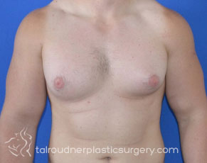 Male Breast Reduction (Gynecomastia)