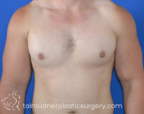 Male Breast Reduction (Gynecomastia)
