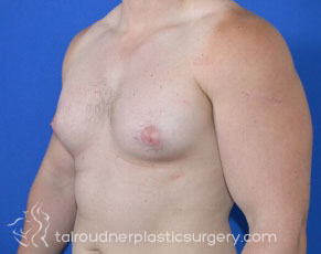 Male Breast Reduction (Gynecomastia)