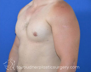 Male Breast Reduction (Gynecomastia)