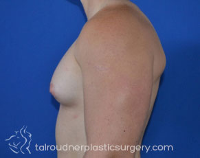 Male Breast Reduction (Gynecomastia)