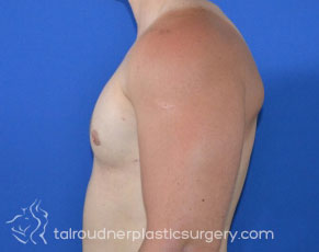 Male Breast Reduction (Gynecomastia)