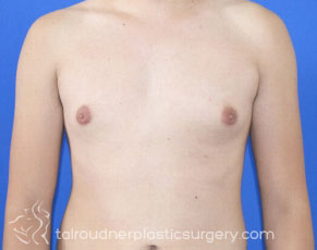 Male Breast Reduction (Gynecomastia)