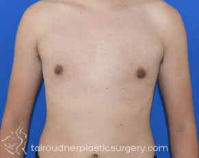 Male Breast Reduction (Gynecomastia)
