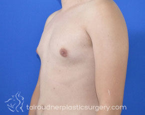 Male Breast Reduction (Gynecomastia)