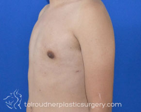 Male Breast Reduction (Gynecomastia)