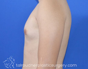Male Breast Reduction (Gynecomastia)