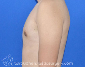 Male Breast Reduction (Gynecomastia)