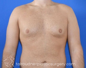 Male Breast Reduction (Gynecomastia)