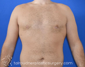 Male Breast Reduction (Gynecomastia)