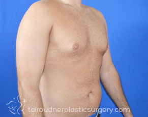 Male Breast Reduction (Gynecomastia)