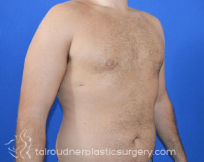 Male Breast Reduction (Gynecomastia)
