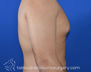 Male Breast Reduction (Gynecomastia)