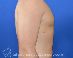 Male Breast Reduction (Gynecomastia)
