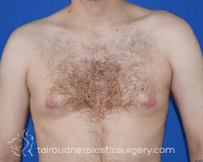 Male Breast Reduction (Gynecomastia)