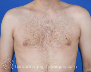 Male Breast Reduction (Gynecomastia)